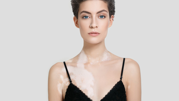 引起白癜風的因素有哪些