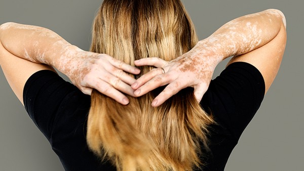 白癜風的人可以吃海帶嗎