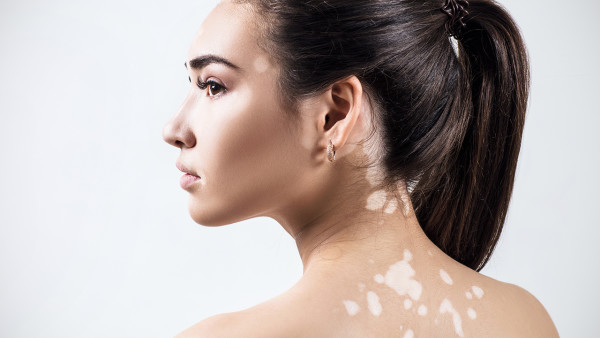 白癜風引發并發癥很多嗎