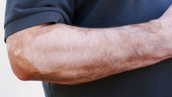 身上的白癜風該怎么護理