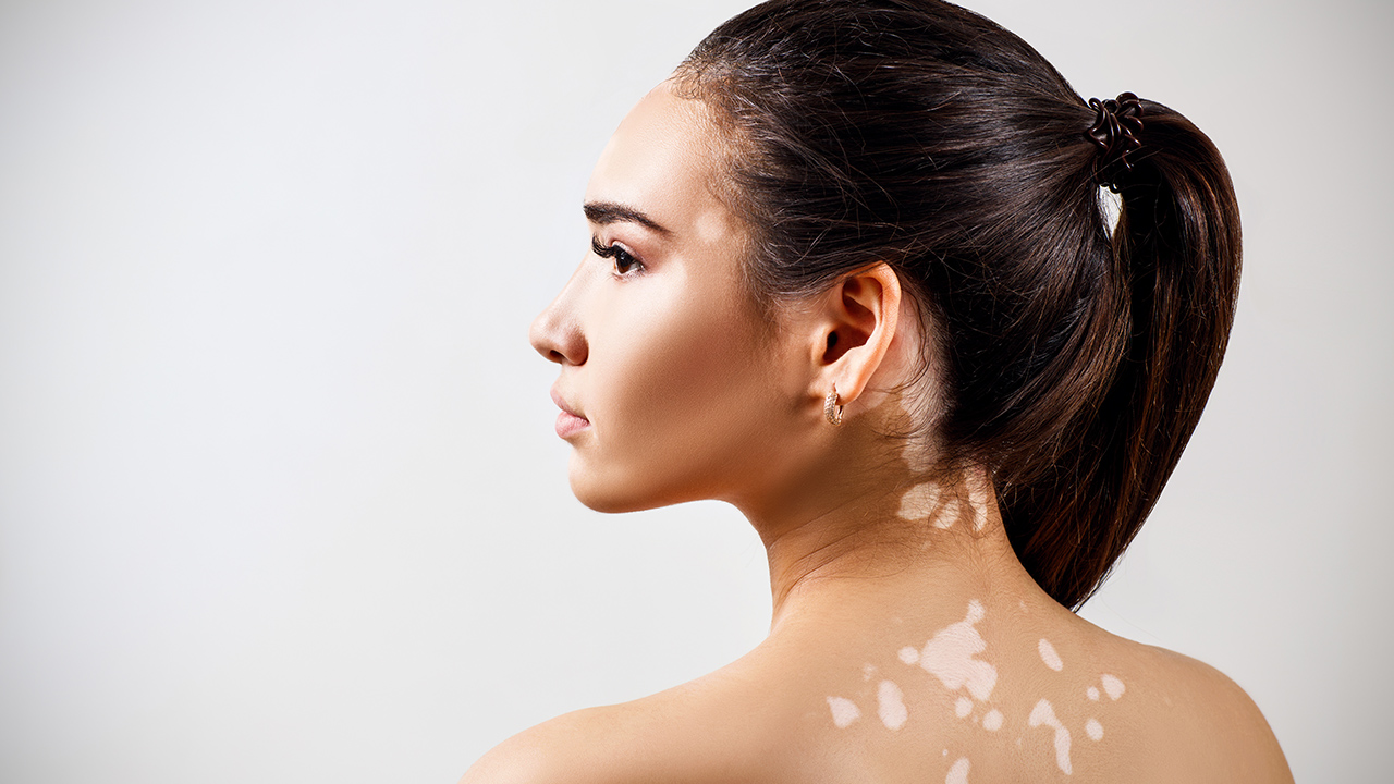 白癜風會因為唾液傳染嗎