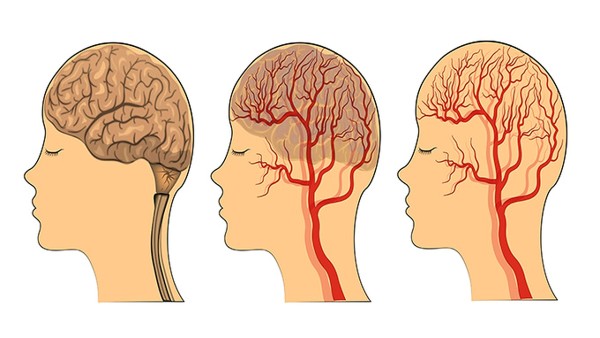 出血性腦卒中的臨床表現(xiàn)有哪些