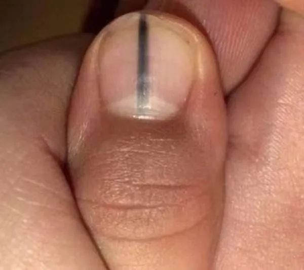 指甲出現一條黑線 別不當回事！可能是癌變
