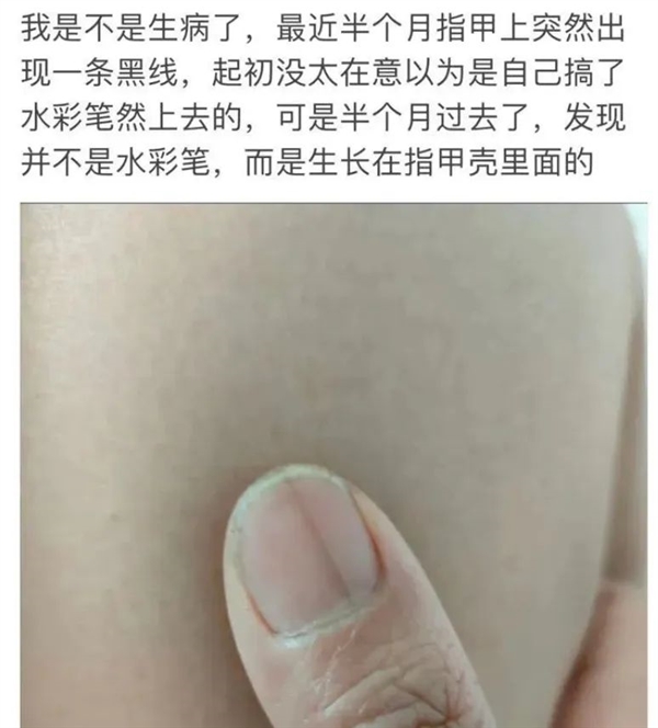 指甲出現一條黑線 別不當回事！可能是癌變